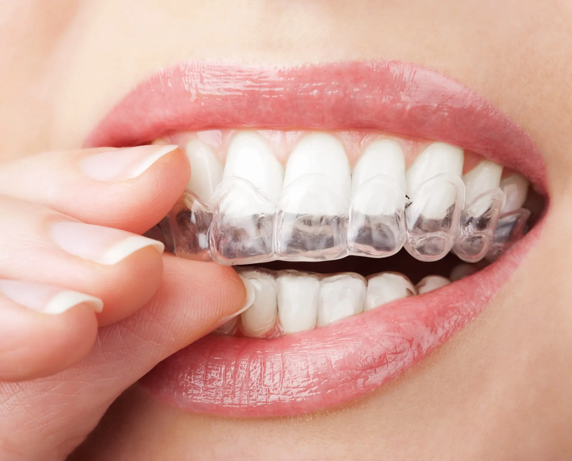 Clear aligner treatment for minor tooth alignment in Concord, North Carolina
