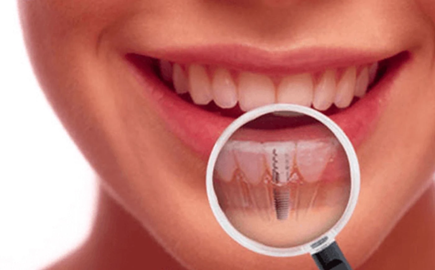 Dental implant treatment and tooth replacement in Concord, North Carolina